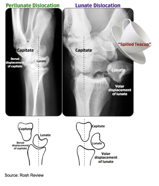 Navigating Lunate and Perilunate Dislocations in the Emergency Department