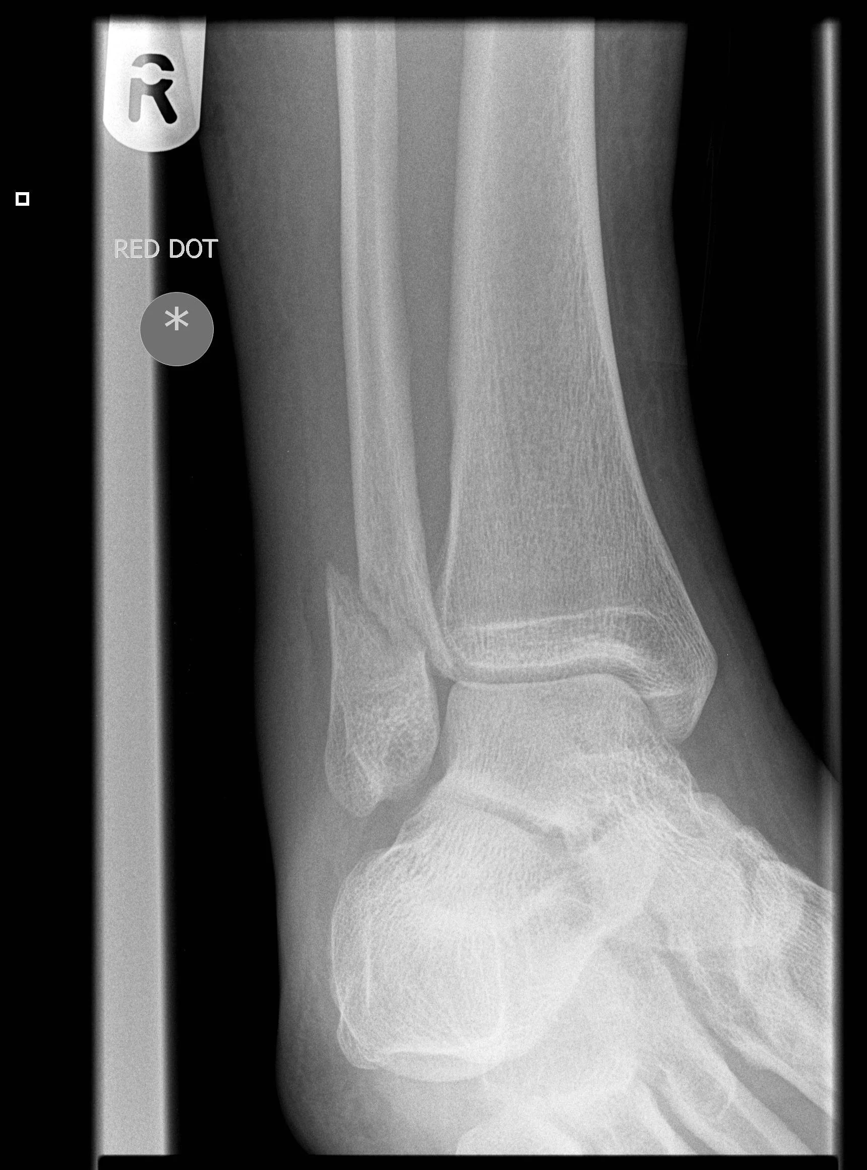 Broken Ankle X Ray What Should I Expect From Ankle Fracture Surgery broken-ankle-x-ray-what-should-i-expect-from-ankle-fracture-surgery