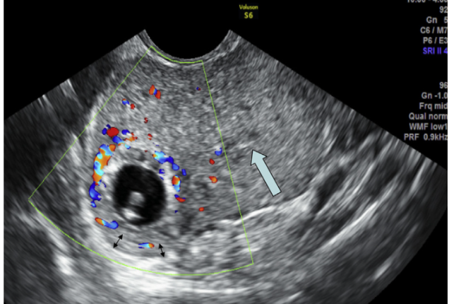 Elective uterine artery embolization prior to laparoscopic resection of  interstitial pregnancy: two cases and literature review | Gynecological  Surgery | Full Text