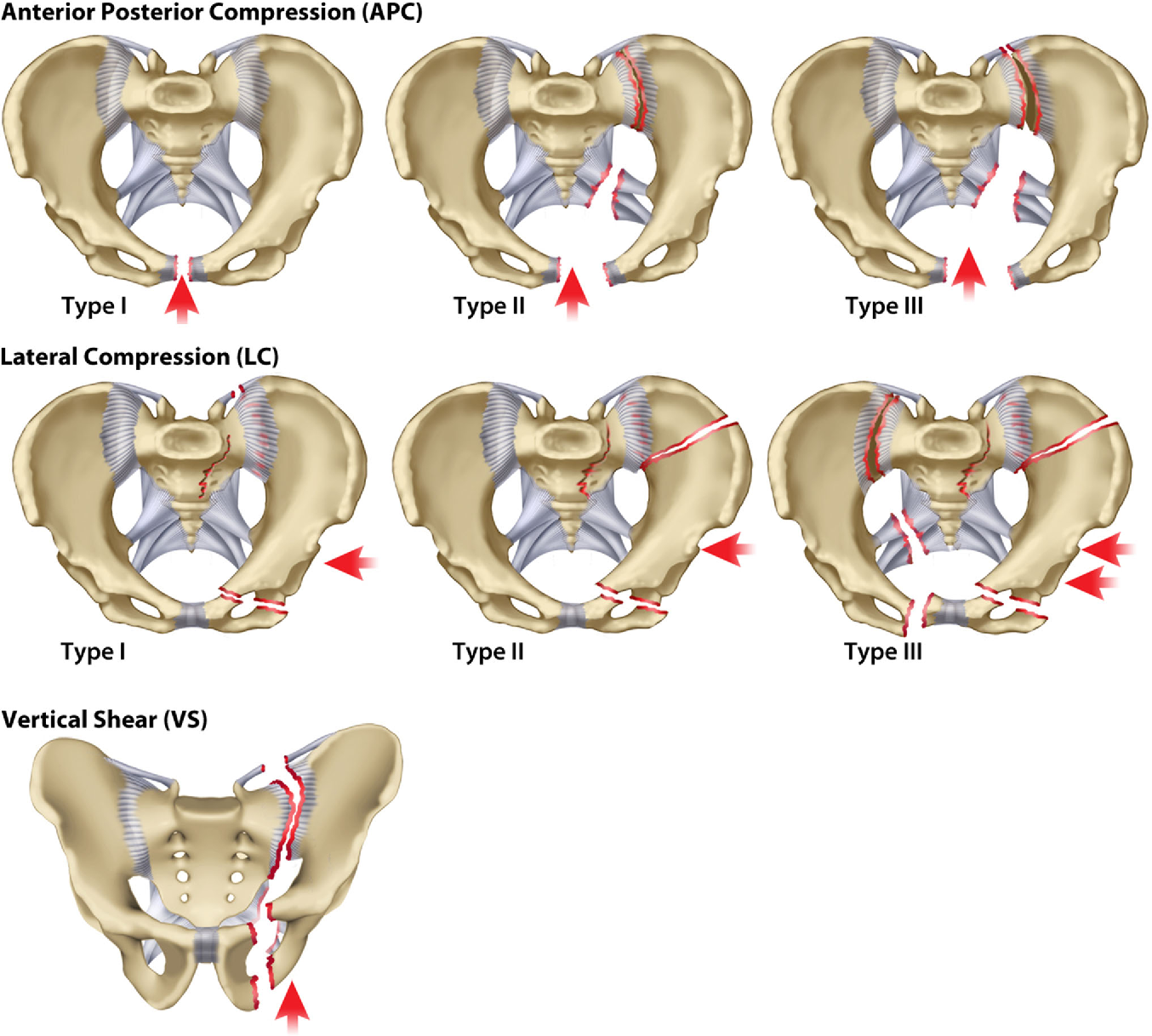 Open book pelvic injury, Radiology Reference Article