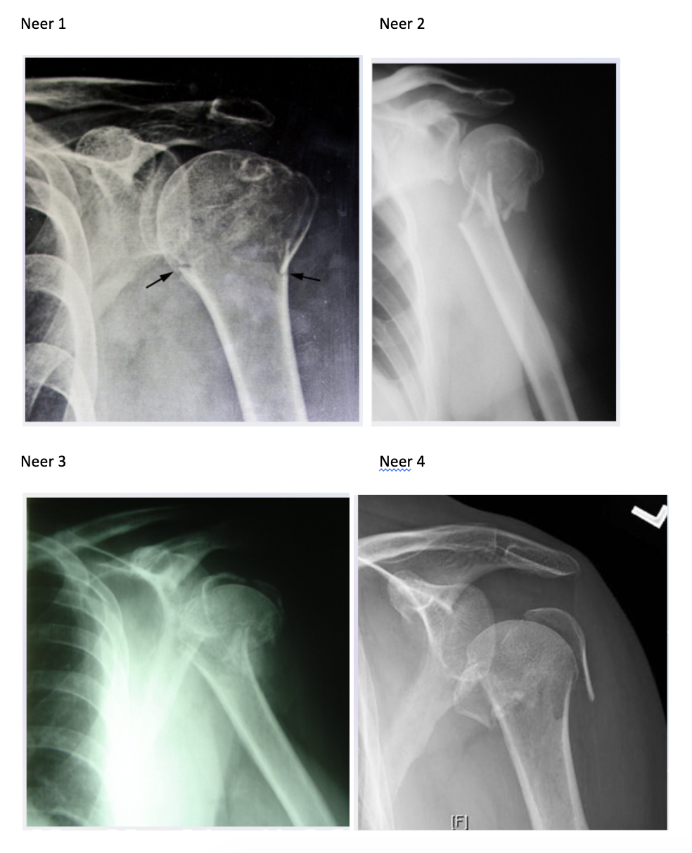 Proximal Humerus Fractures