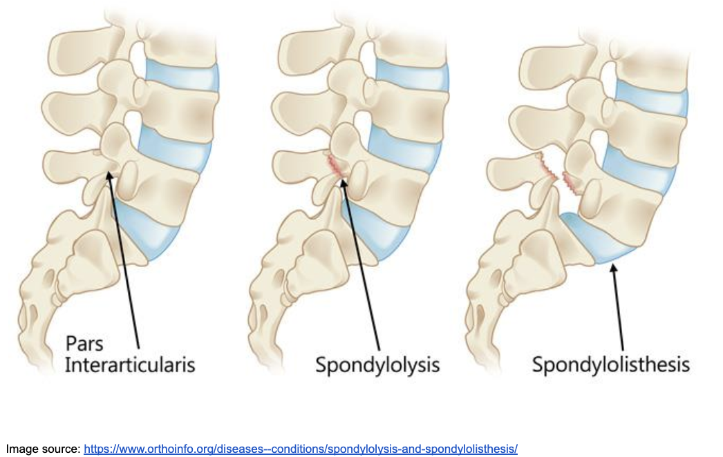 Spondylo-WHAT?