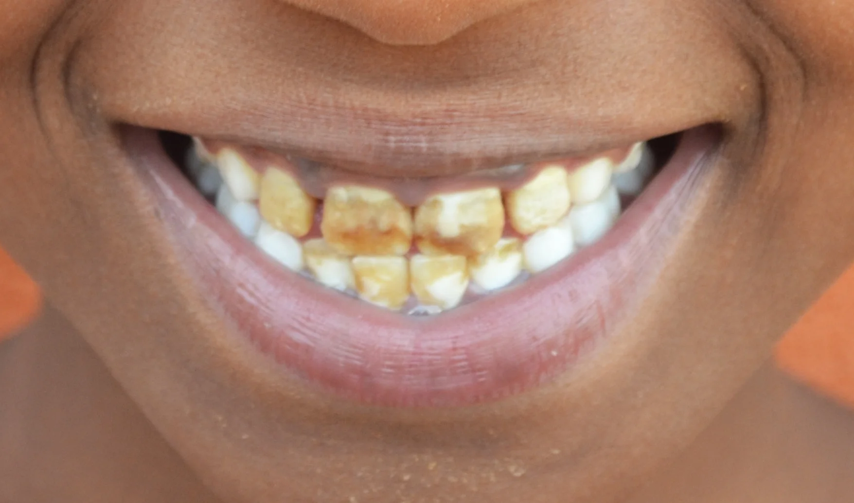 *Angie’s teeth are brown and broken because of high fluoride.