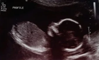 Ultrasound Picture Edited.jpeg