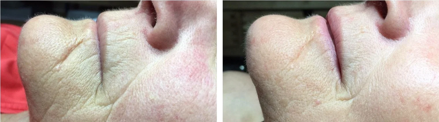 Used Celluma two times a week for 4 weeks. Pictures from Celluma website .