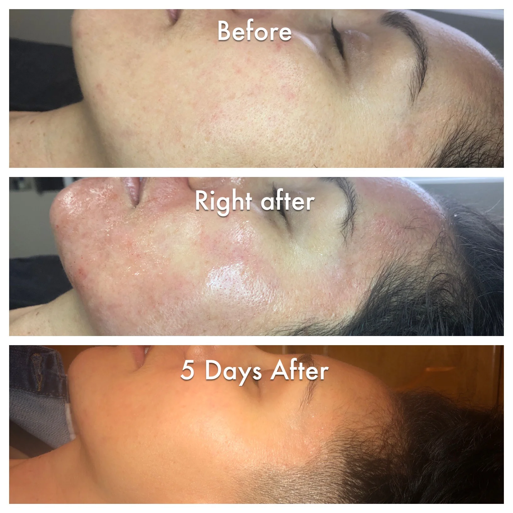 gone wrong microneedling before and after 1 treatment