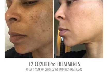 Co2 Lift Carboxy Treatment — hannah brie esthetics