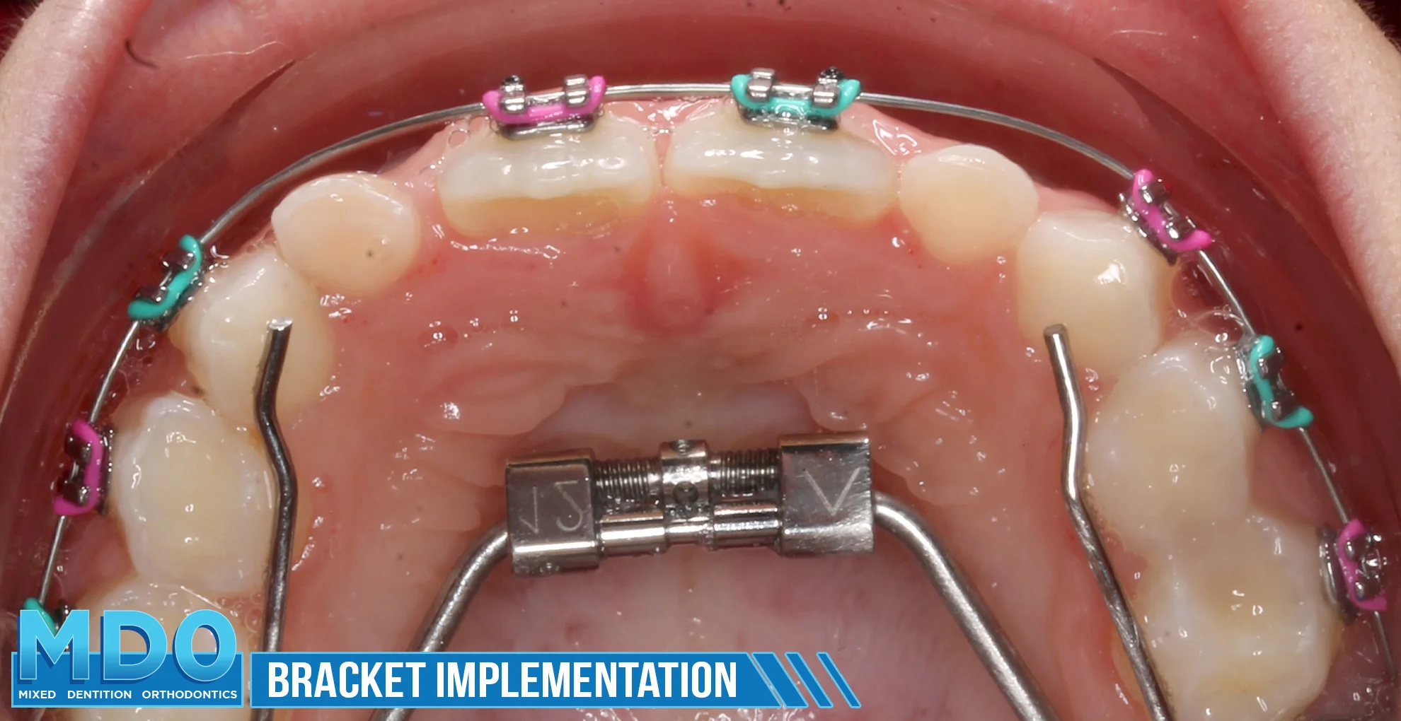 Bracket Implementation 1 Henrietta 5.jpg
