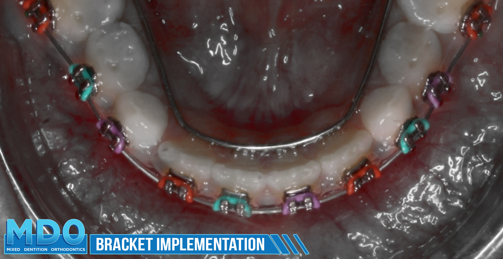 Bracket Implementation 2 Isabella 2.jpg