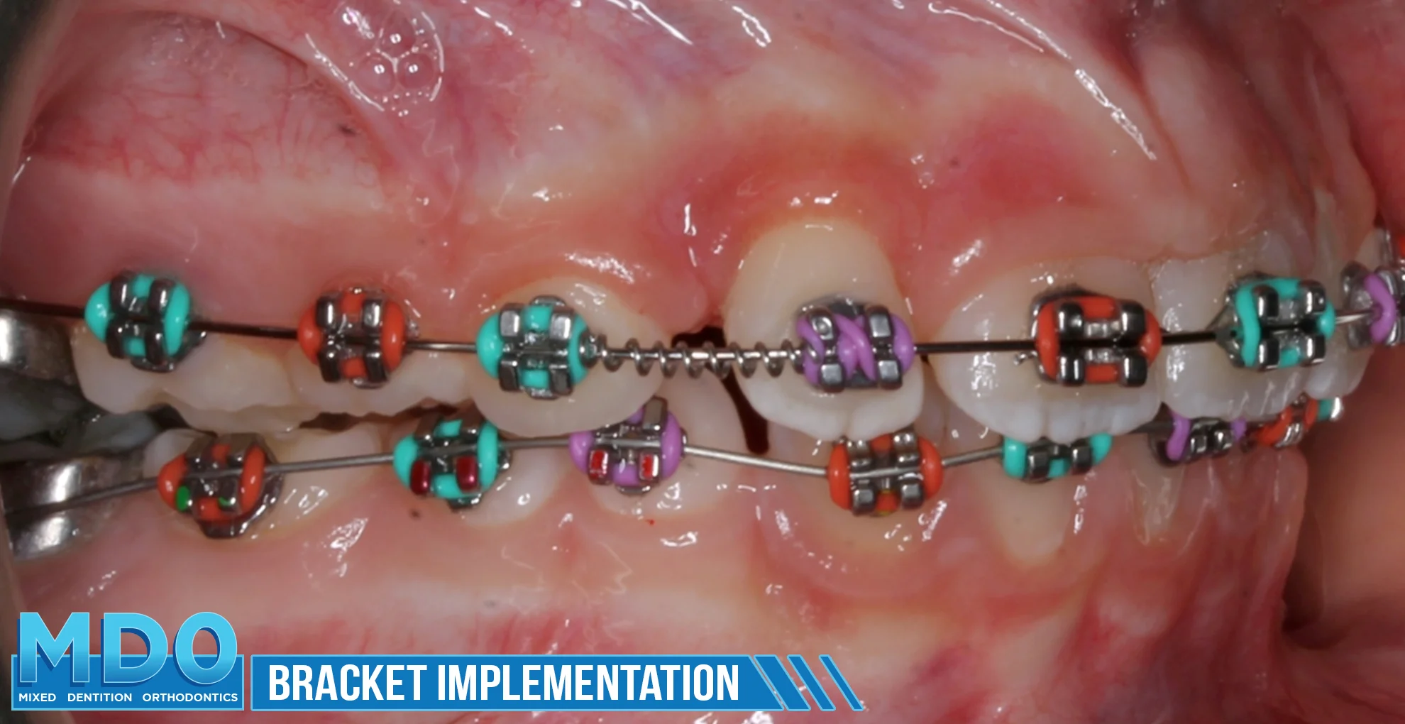 Bracket Implementation 2 Isabella 3.jpg