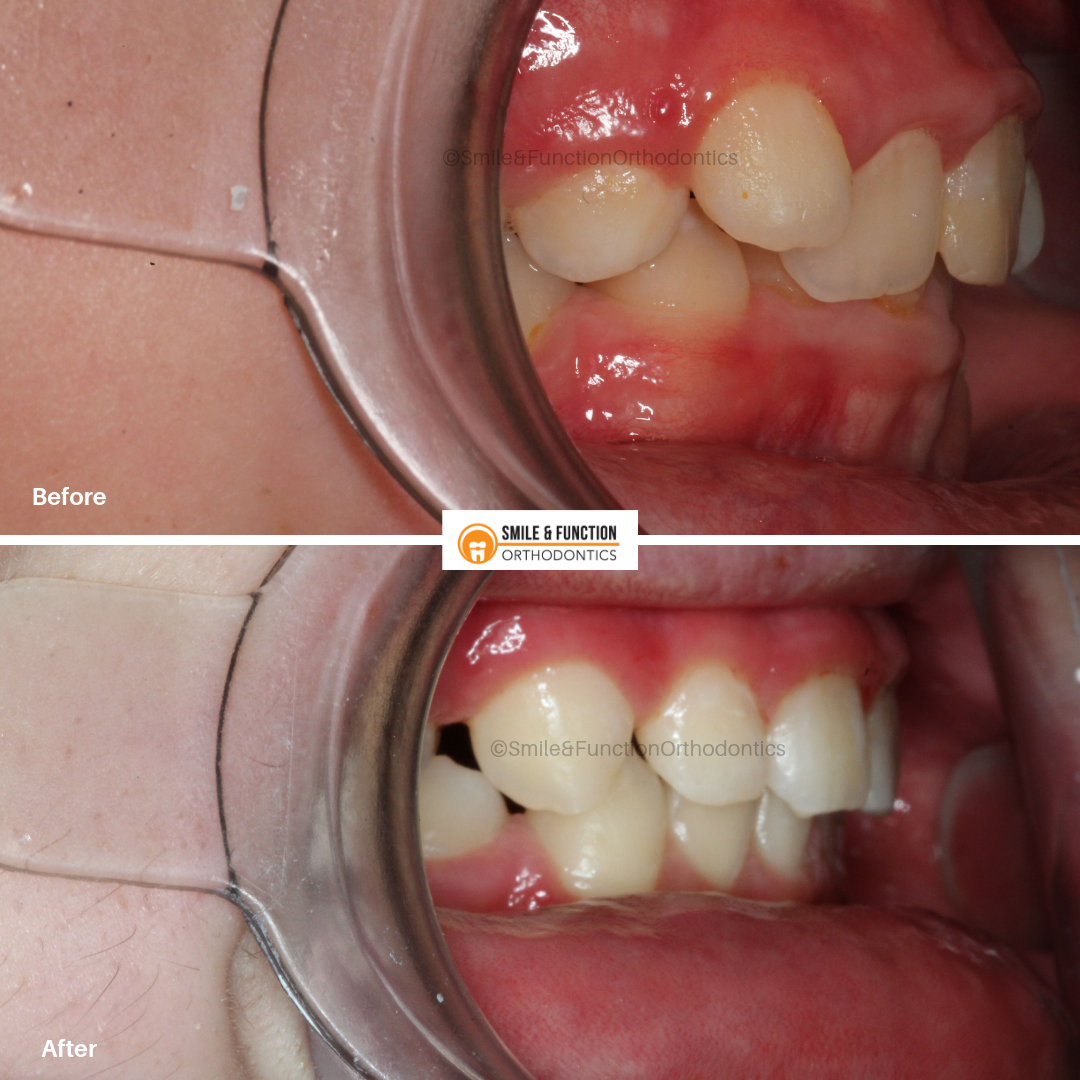 SFO Geoff Case 2 lateral teeth view BF and AF.png