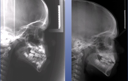 Lateral ceph before (L) and after (R) treatment