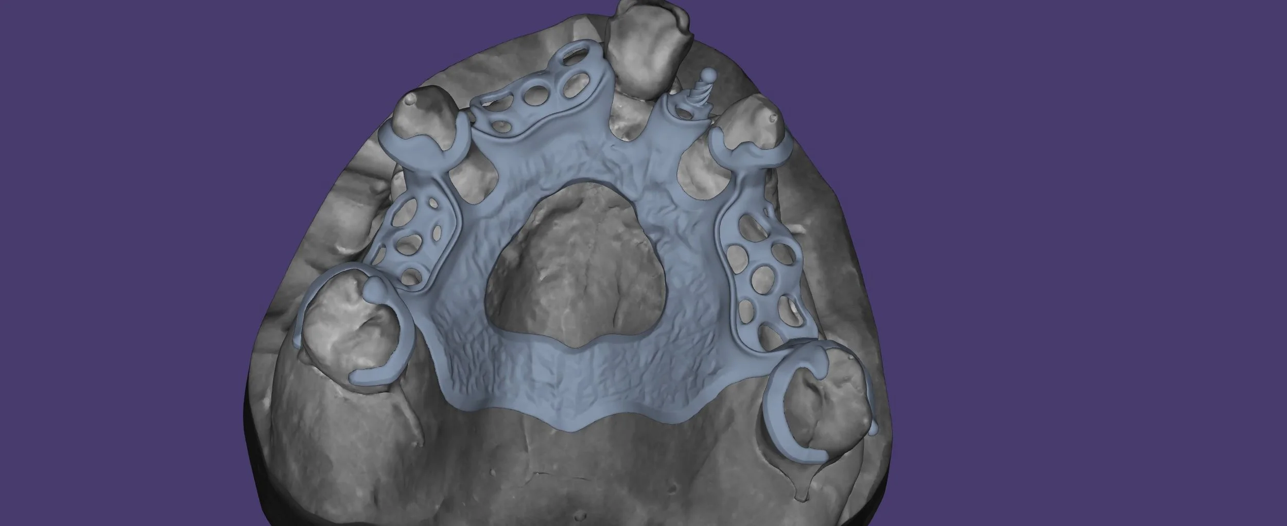 3D-Druckmodell eines menschlichen Oberkieferknochens mit eingebauten Zahnersatzstrukturen aus Kunststoff in Blau.