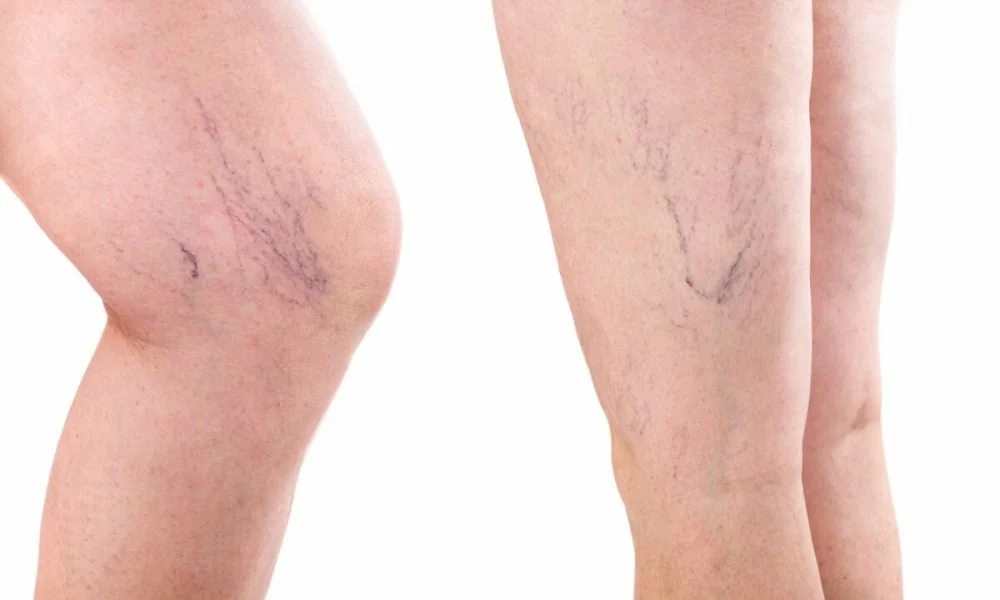 Spider Veins: Five Causes That You Might Not Know About