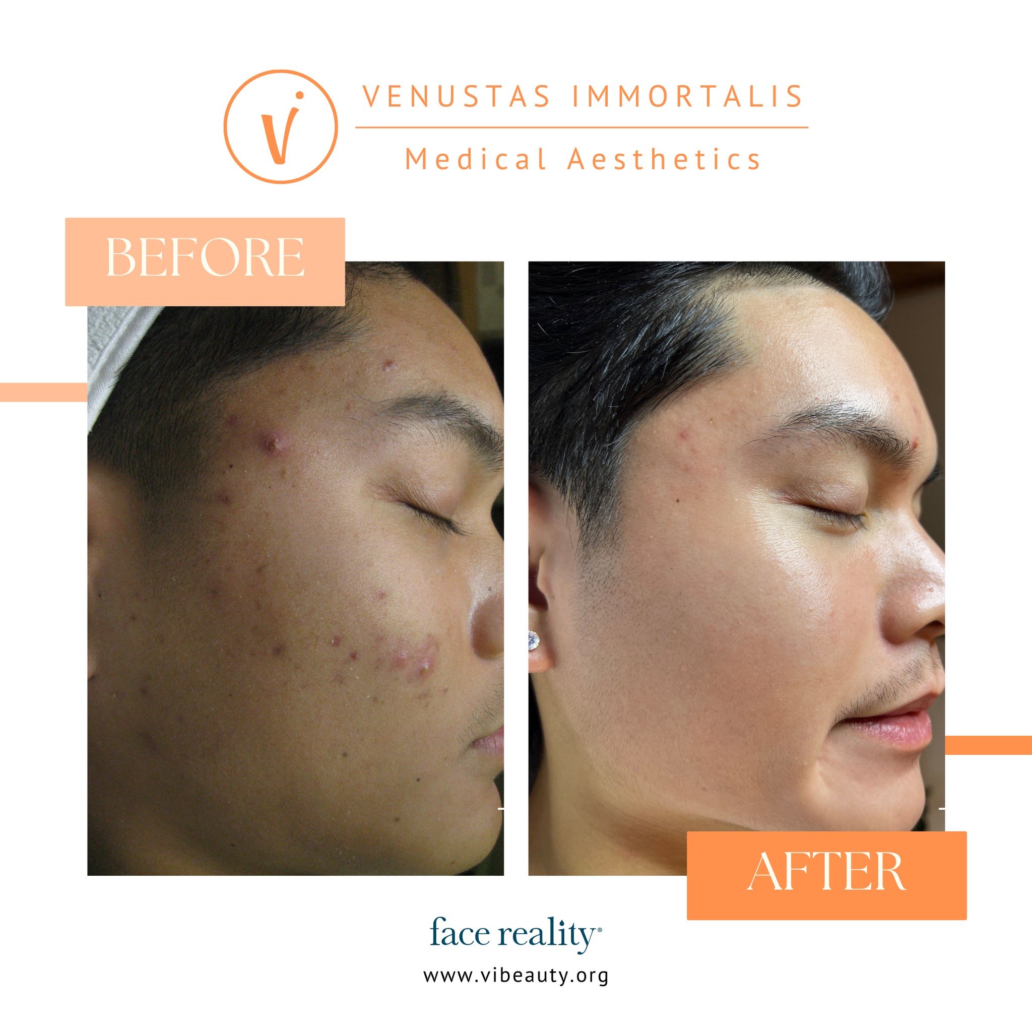 Clear skin is possible with the right acne treatments!🌟 Don't let breakouts hold you back. Take charge of your skin and discover the solutions that work for you. Learn more at vibeauty.org/acne-concerns #clearskintips #acnetreatment #acneproblems #b