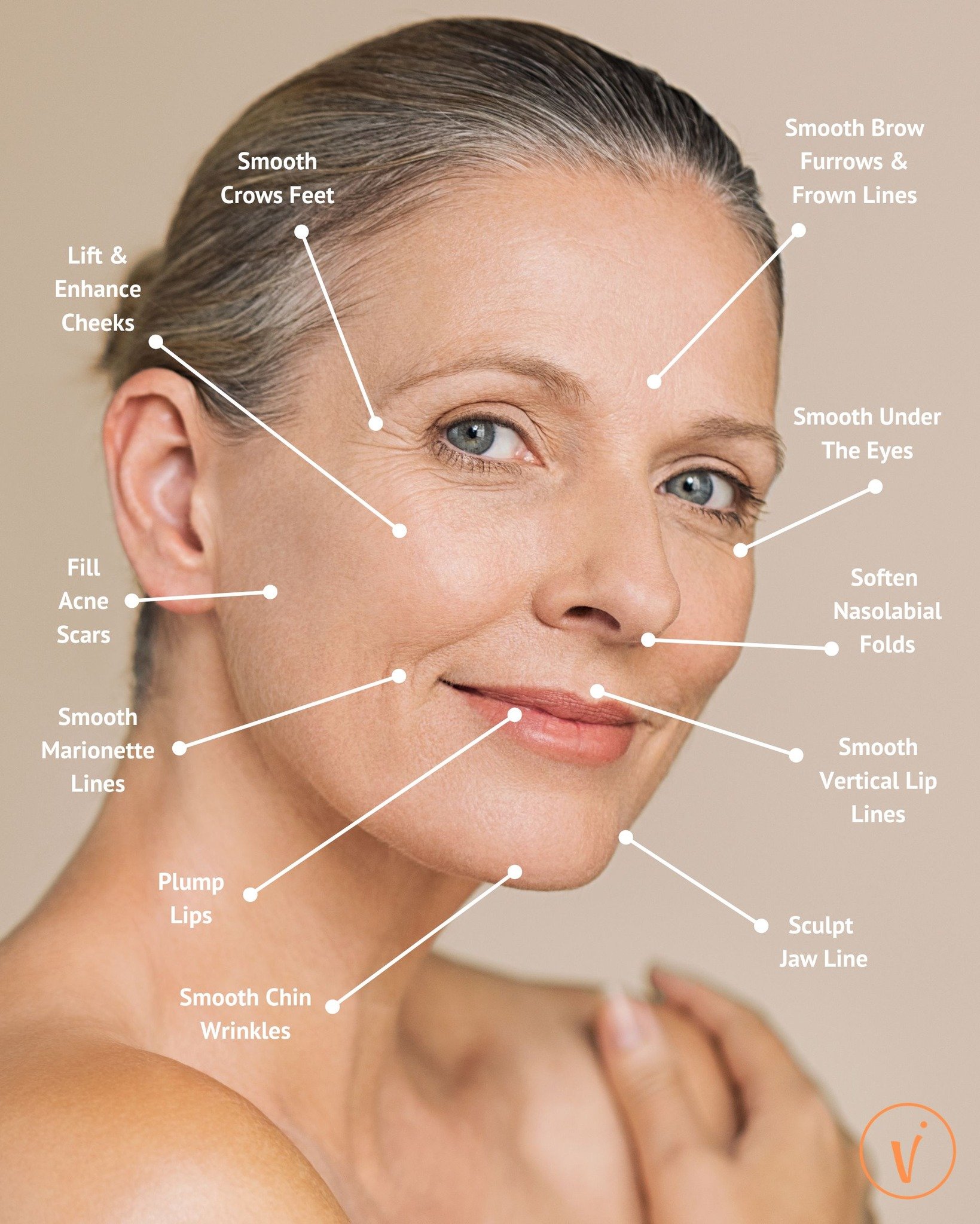 As we age, our facial structure changes. With time, our cheek bones flatten, and we lose our fat pads and the supportive collagen matrix in our skin. The result is hollow or sunken spaces, and deep lines and folds. Dermal fillers are a soft, gel like