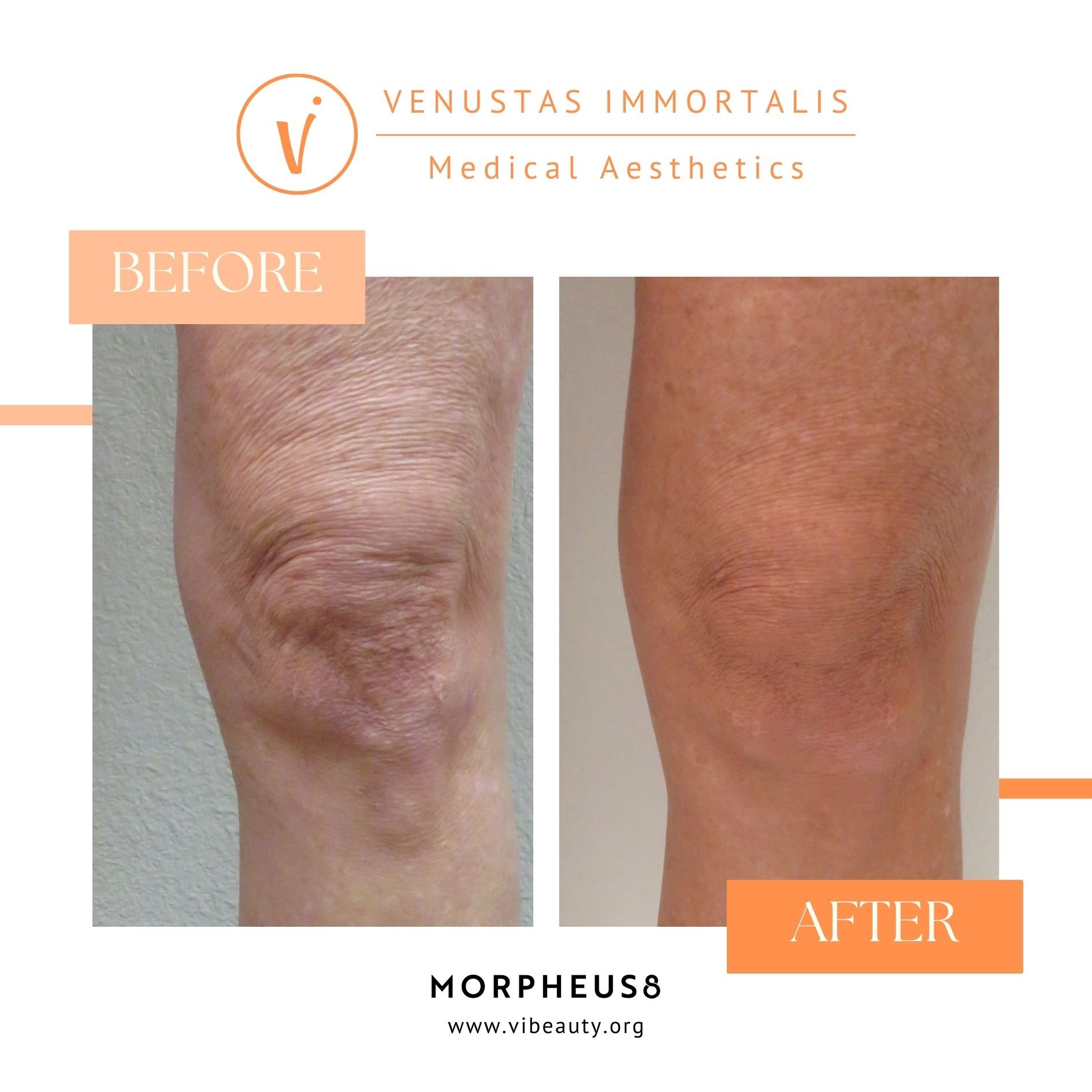 Morpheus8 Body is a radiofrequency (RF) microneedling treatment that tightens skin, liquefies fat, and reduces the appearance of cellulite, all while improving the overall tone and texture of the skin!😍✨

Equipped with &ldquo;Burst Mode&rdquo; techn