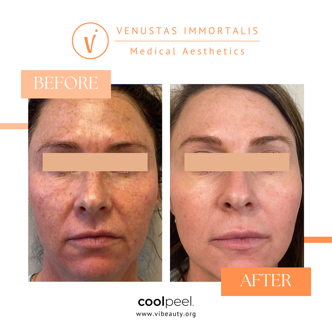coolpeel-co2-laser-before-after-milton-wi-sun-damage.jpg