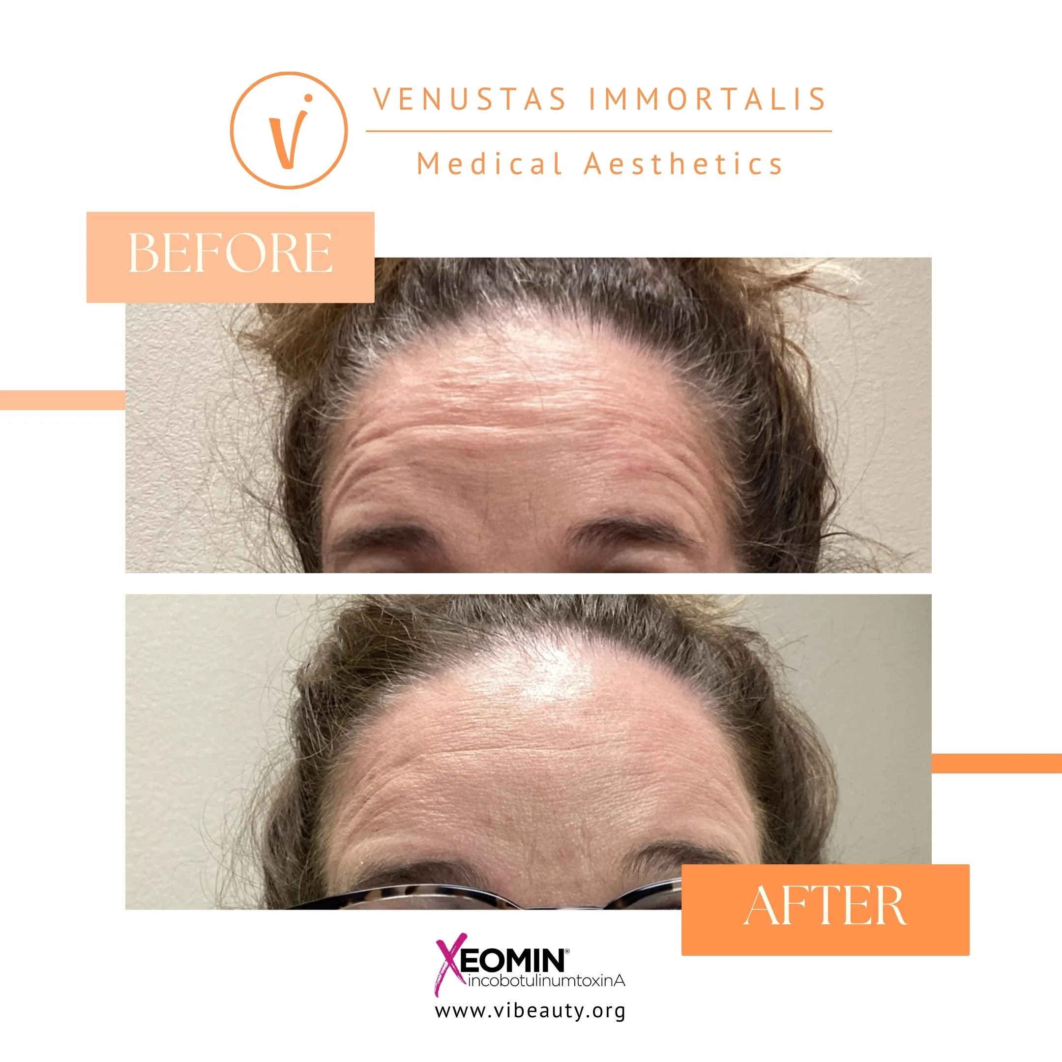 Xeomin-Botox-forehead-before-after-Med-Spa-Janesville-Wisconsin.jpg
