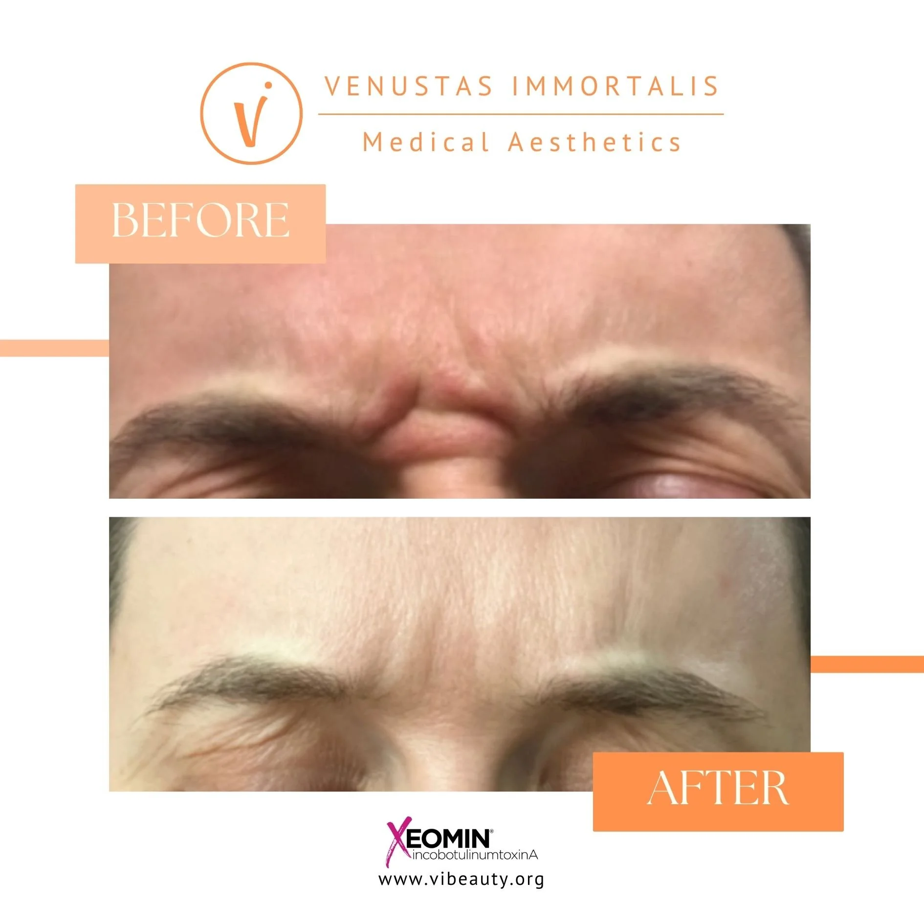Xeomin-Botox-Injections-before-after-Med-Spa-Dubuque-Iowa.jpg