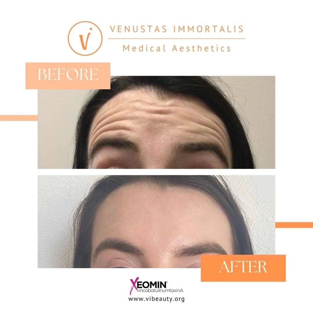 botox-treatment-forehead-before-after-milton-wi-med-spa.jpg