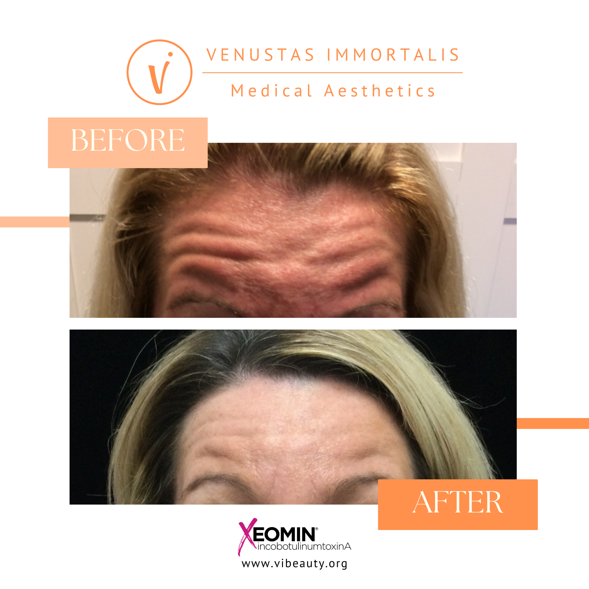 Xeomin-Botox-Injections-forehead-before-after-Med-Spa-NewGlarus-Wisconsin.jpg