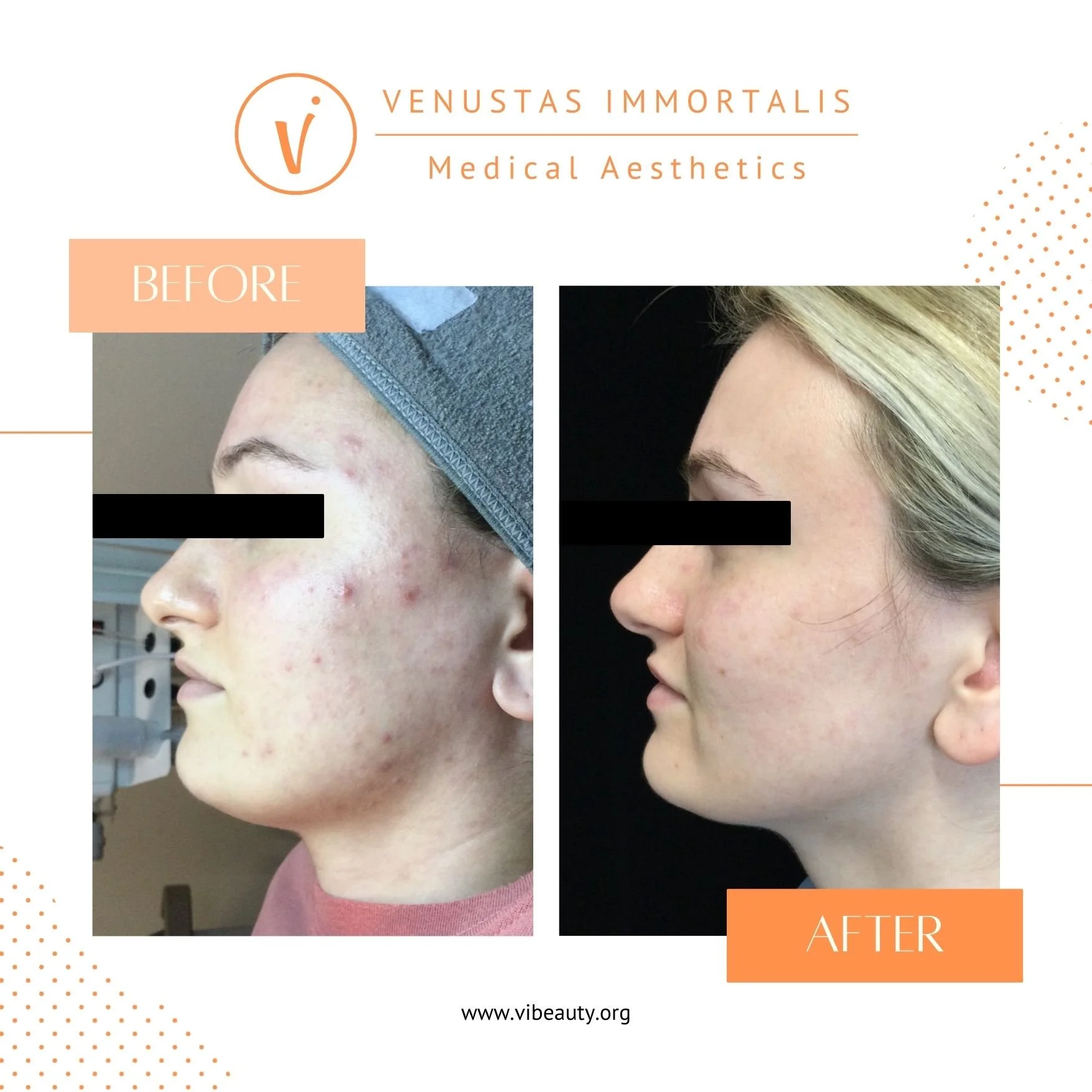 acne-treatment-before-after-med-spa-janesville-wi.jpg