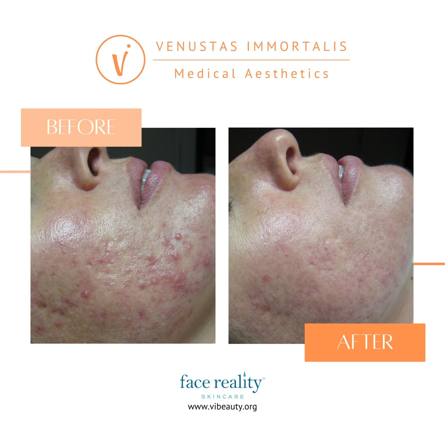 face-reality-acne-before-after-med-spa-milton-wi.jpg
