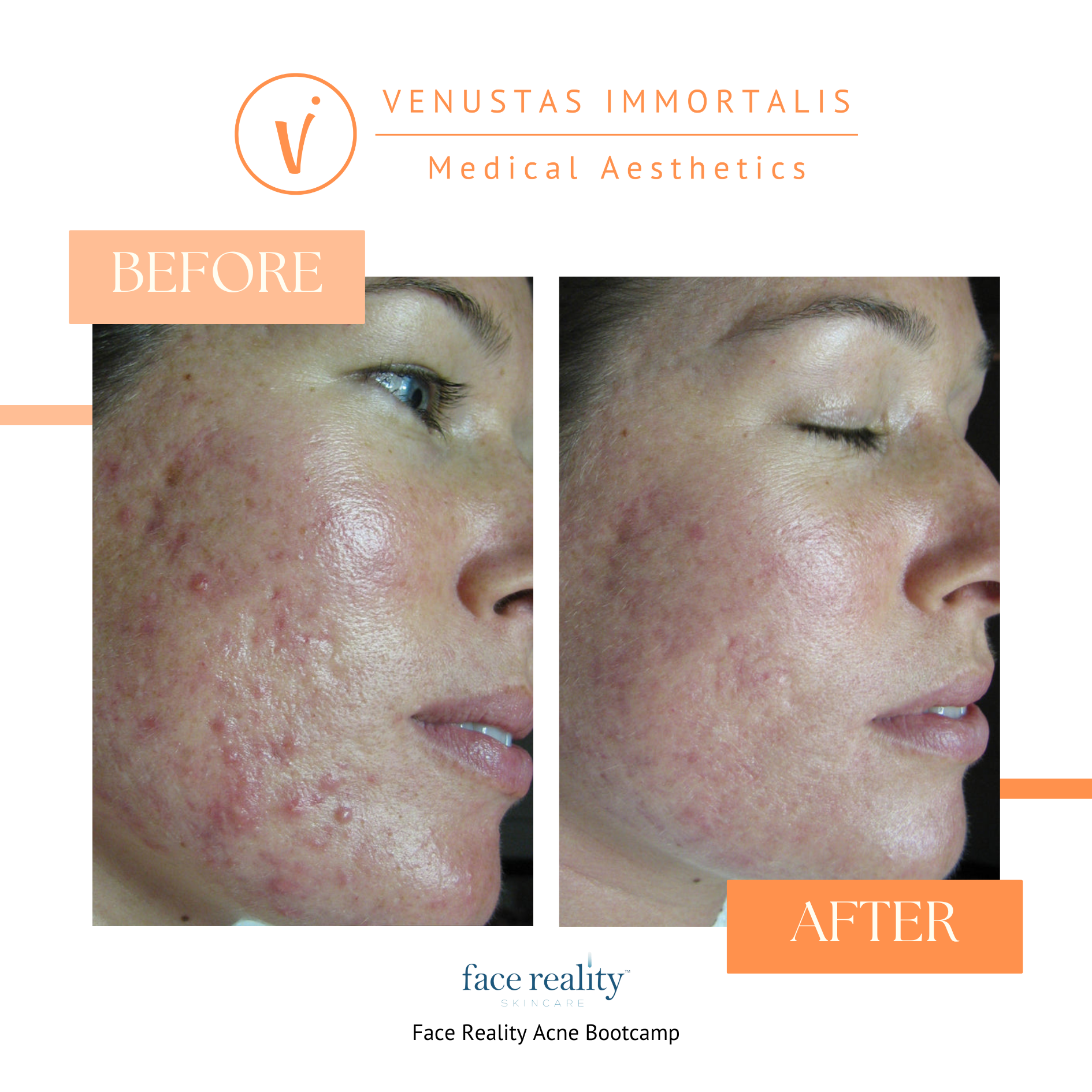 acne-treatment-before-after-med-spa-milton-wisconsin.jpg