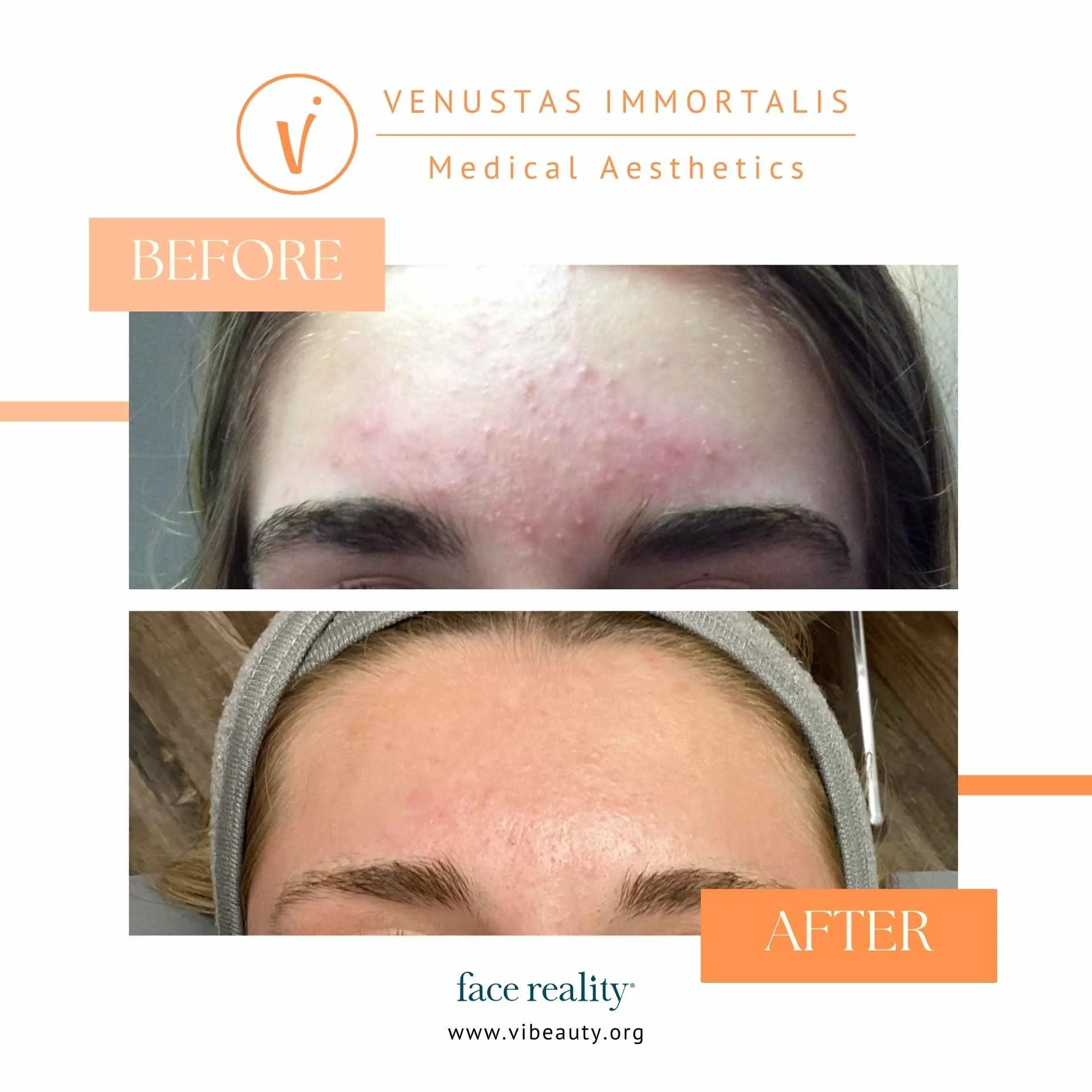 face-reality-acne-before-after-med-spa-janesville-wi.jpg