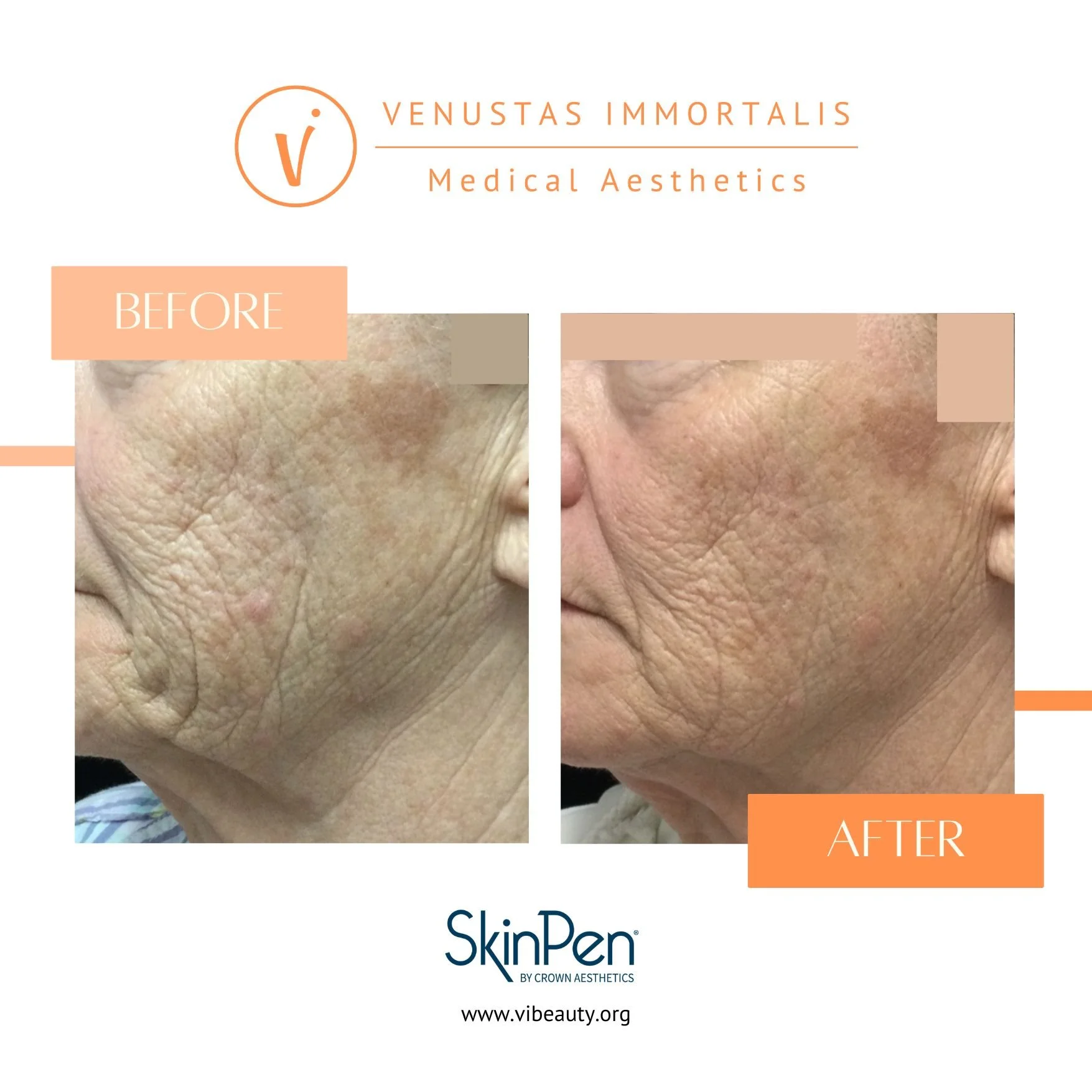 skinpen-microneedling-before-after-venustas-immortalis-med-spa-dubque-ia.jpg