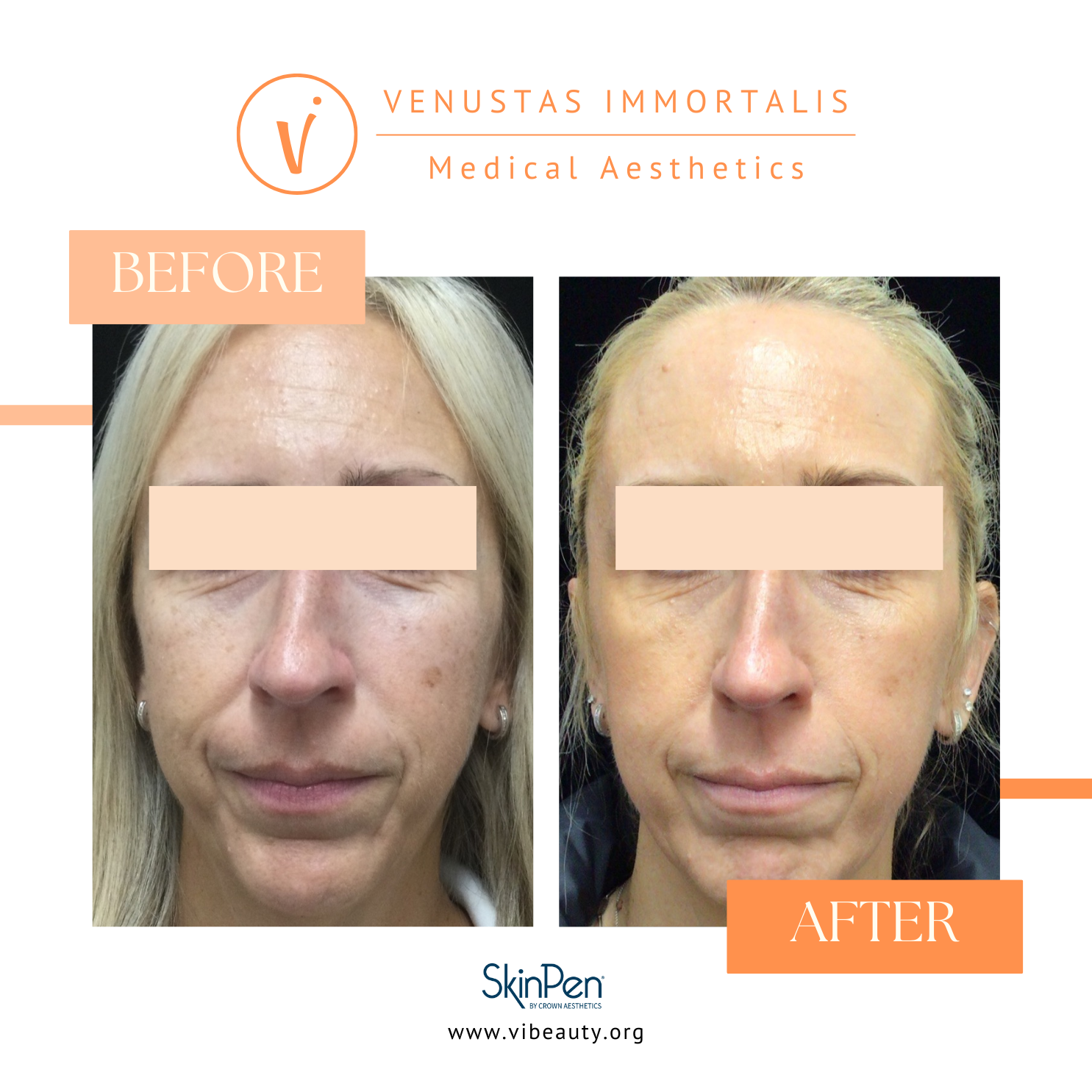 skinpen-microneedling-before-after-venustas-immortalis-med-spa-milton-wi.jpg