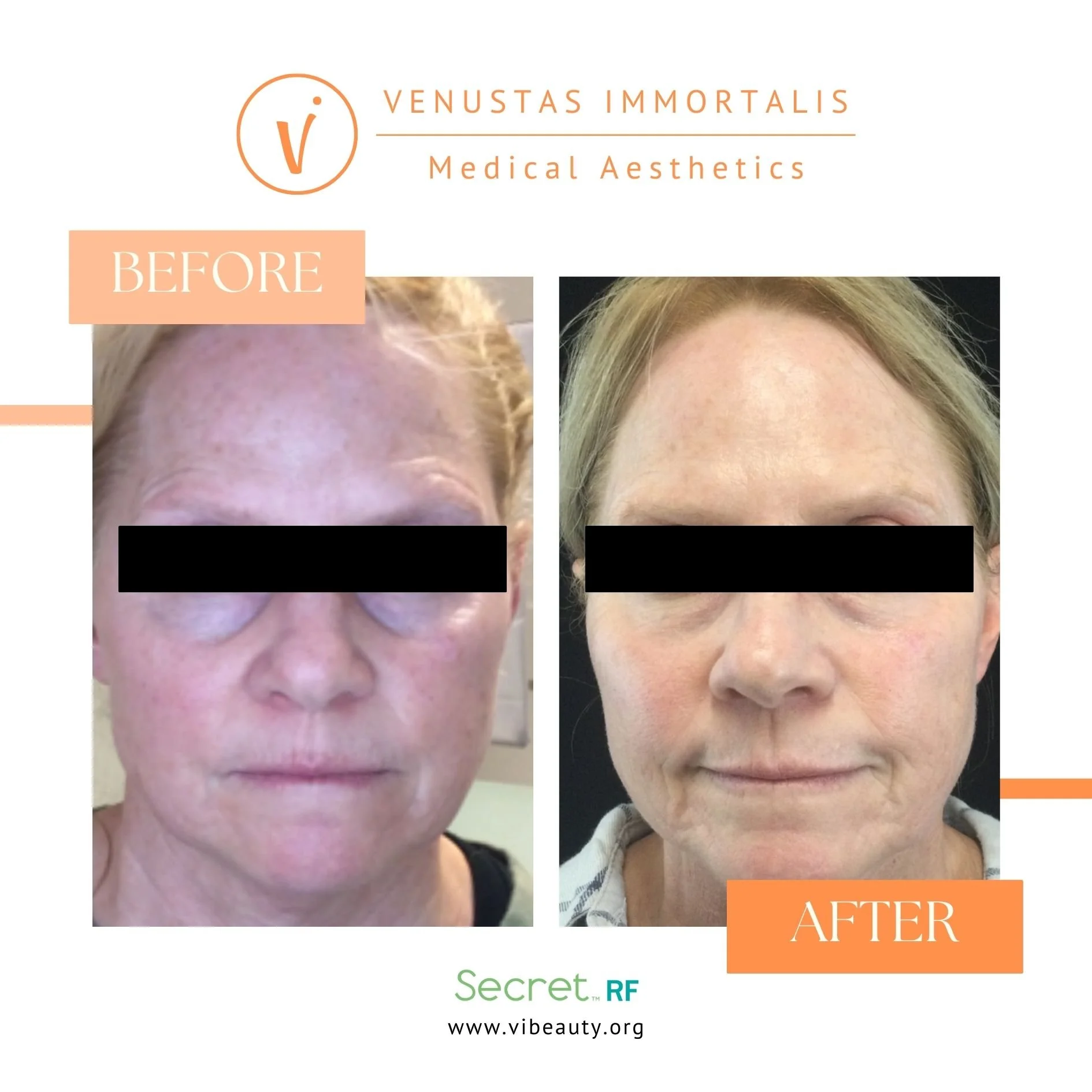 rf-microneedling-fine-lines-before-after-janesville-wi.jpg