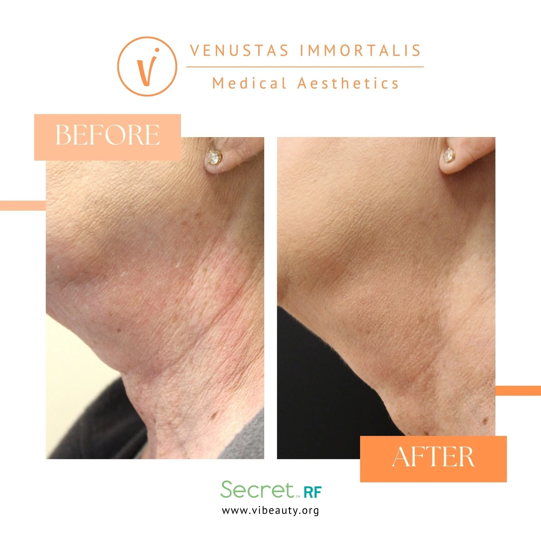 rf-microneedling-neck-before-after-dubuque-ia.jpg
