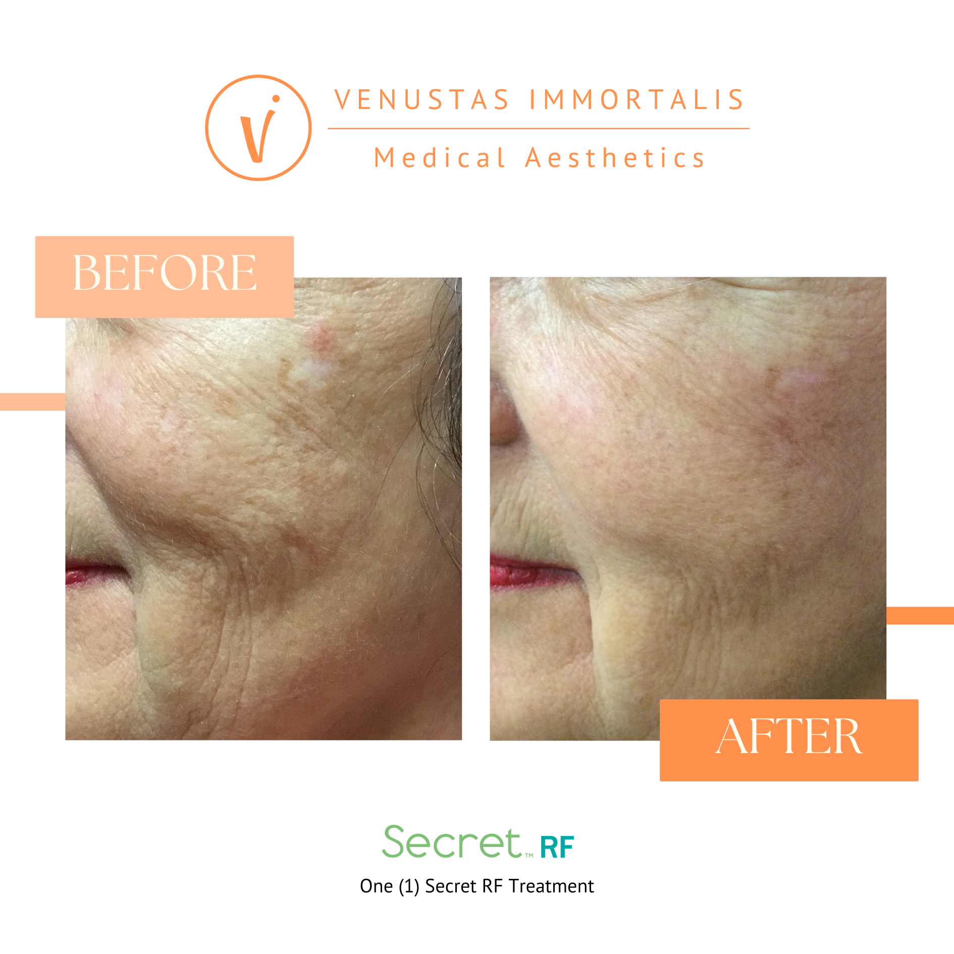rf-microneedling-acne-scars-before-after-janesville-wi.jpg