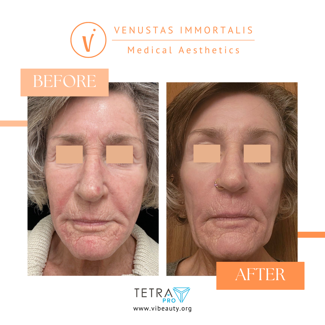 tetra-pro-co2-laser-before-after-milton-wi-skin-rejuvenation.jpg