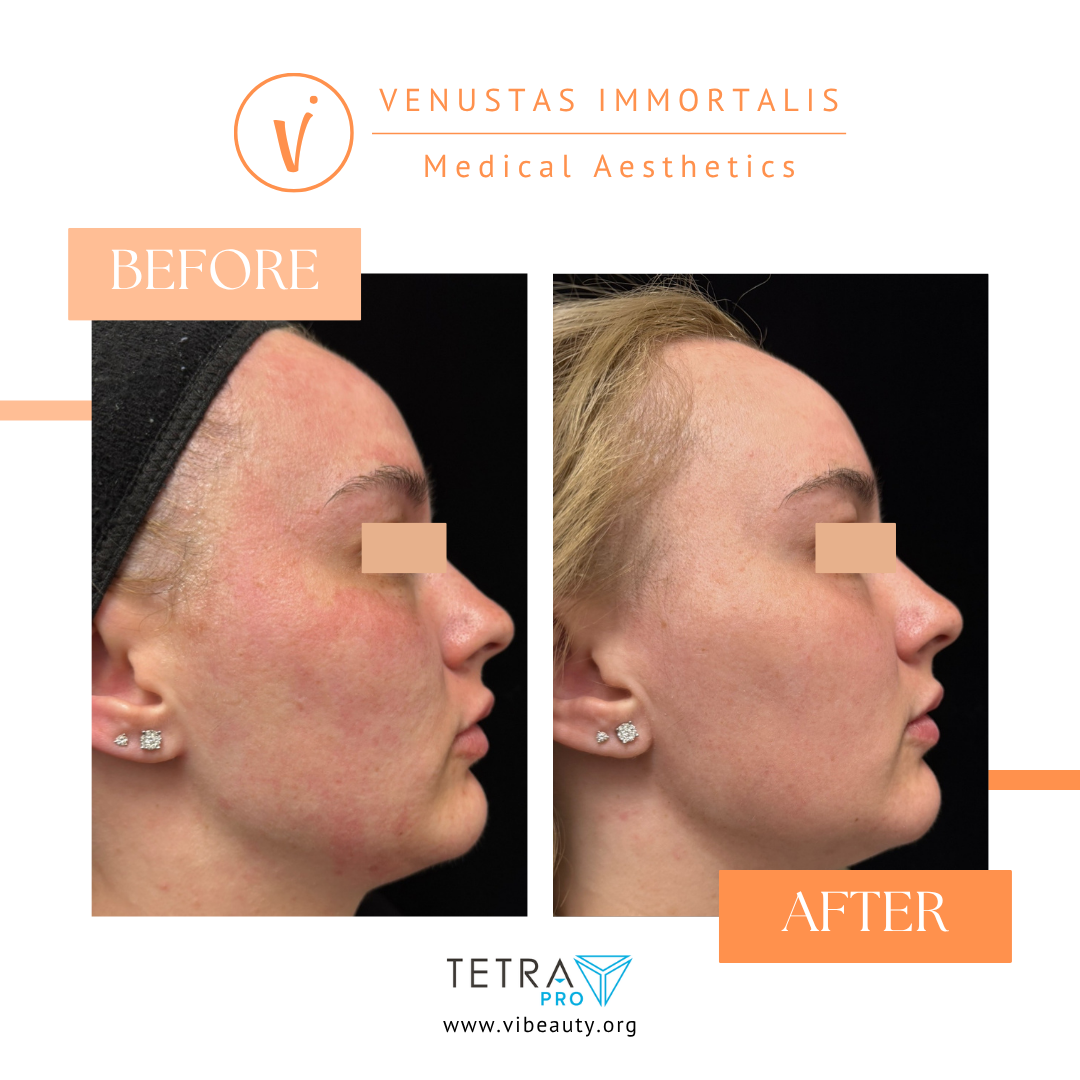 co2-deka-laser-before-after-milton-wi-skin-rejuvenation.jpg