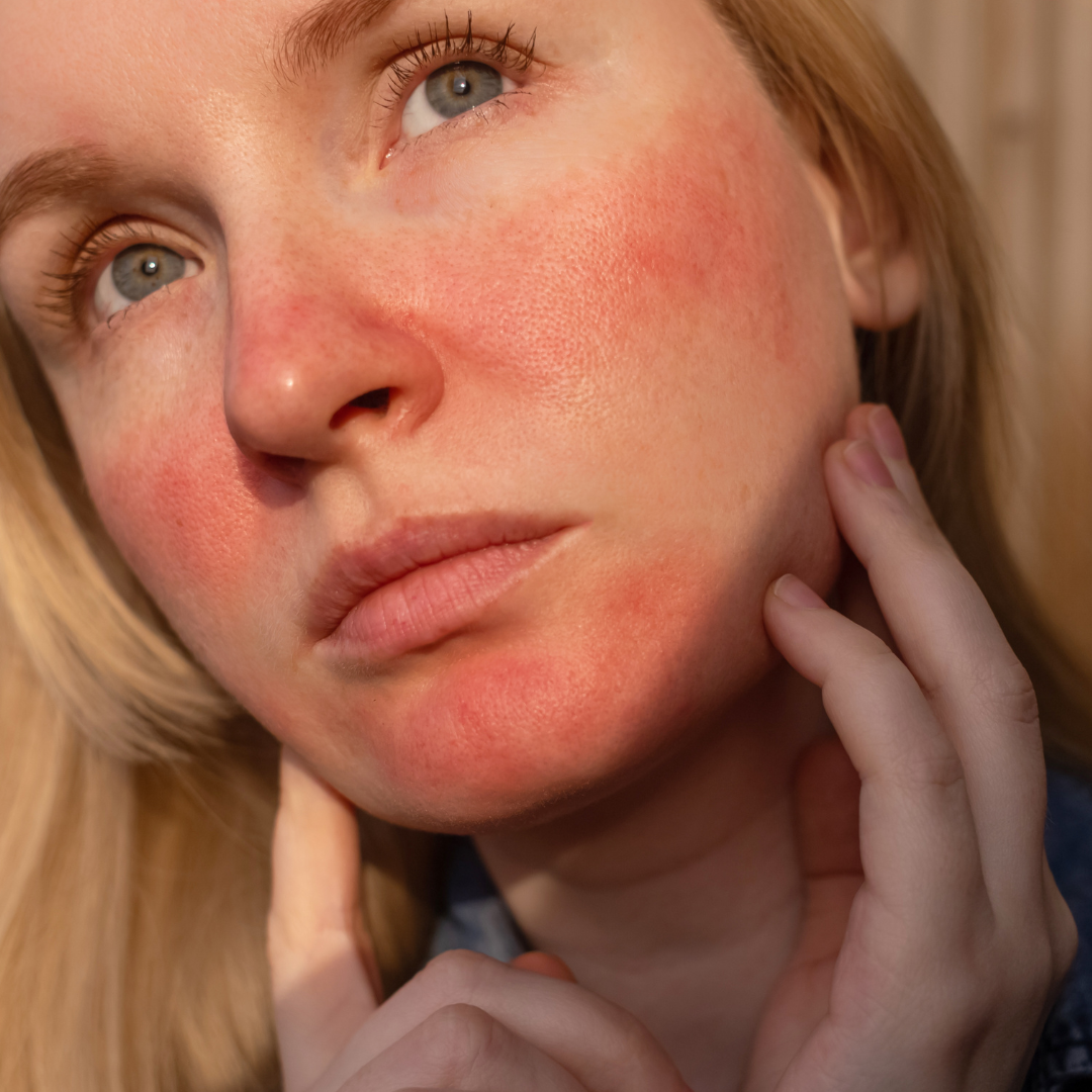 Rosacea & Redness Relief at Venustas Immortalis Med Spa in Dubuque, Iowa