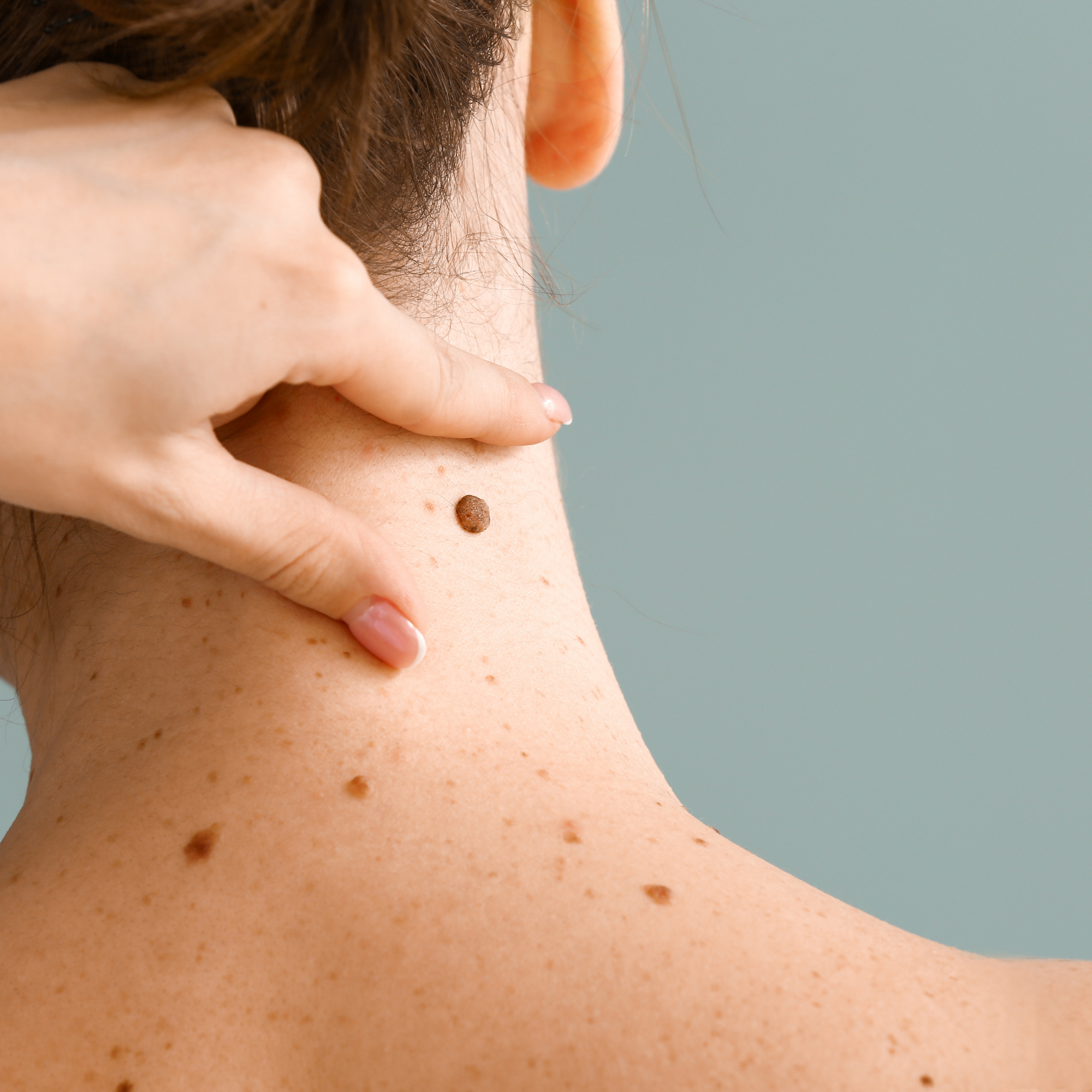 Skin Lesion Removal at Venustas Immortalis Med spa in New Glarus and Janesville, Wisconsin and Dubuque, Iowa