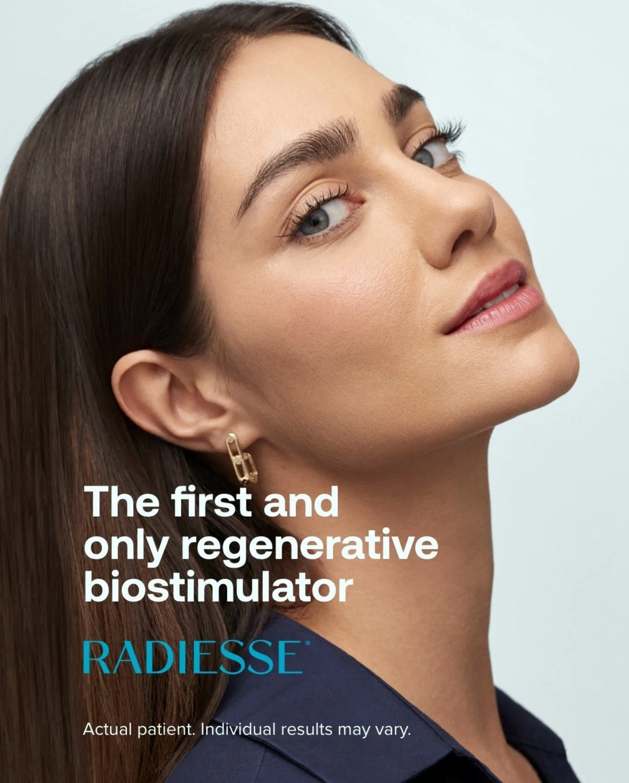 Radiesse Biostimulator Treatment at Venustas Immortalis Med Spa in Dubuque, Iowa
