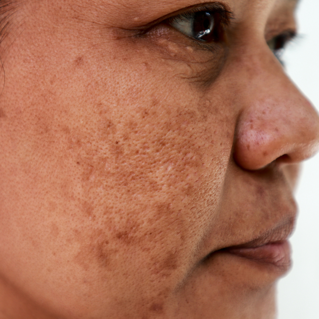 Laser Pigment Treatment for Brown Pigment & Sun Damage at Venustas Immortalis in Dubuque, Iowa