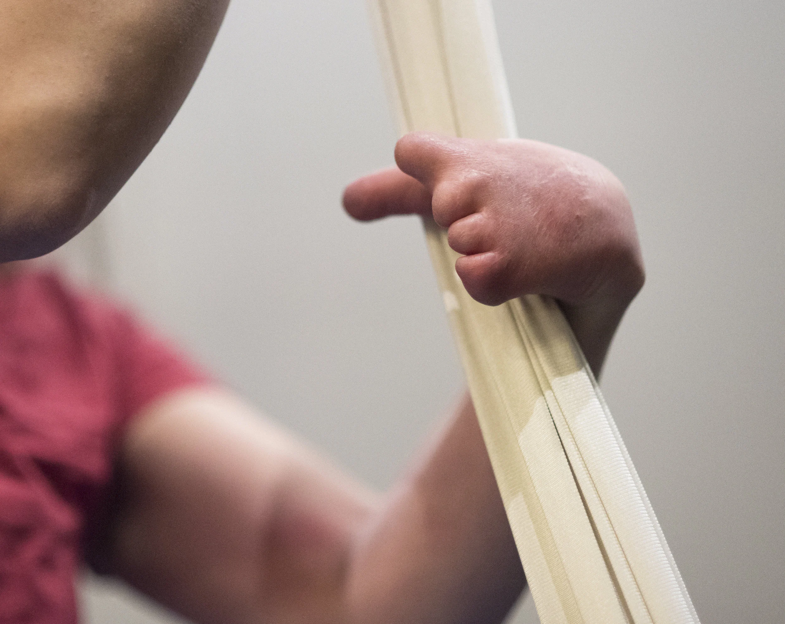  Sarah Tuberty was born with Symbrachydactyly, a congenital abnormality caused by blood clotting in utero. Tuberty has limited use of her left hand (pictured), which has no fingers with the exception of a non-opposable thumb and typically uses her le