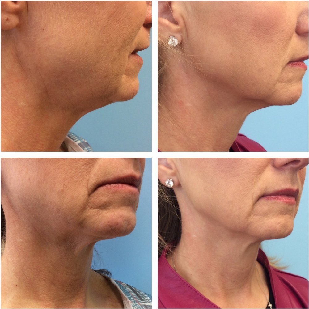 How Long Does Ultherapy Last