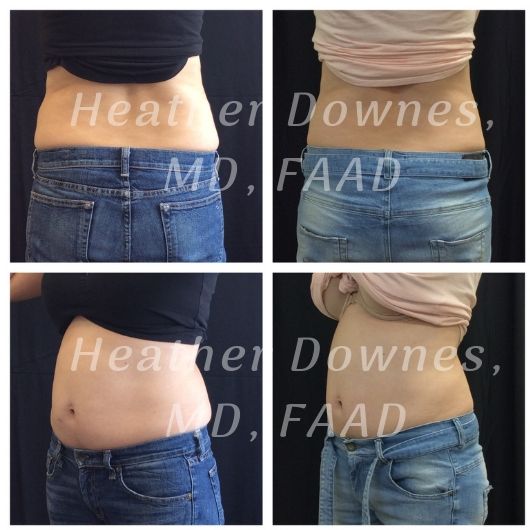 Chicago's Best Flank Fat Removal: Get Results Without Liposuction