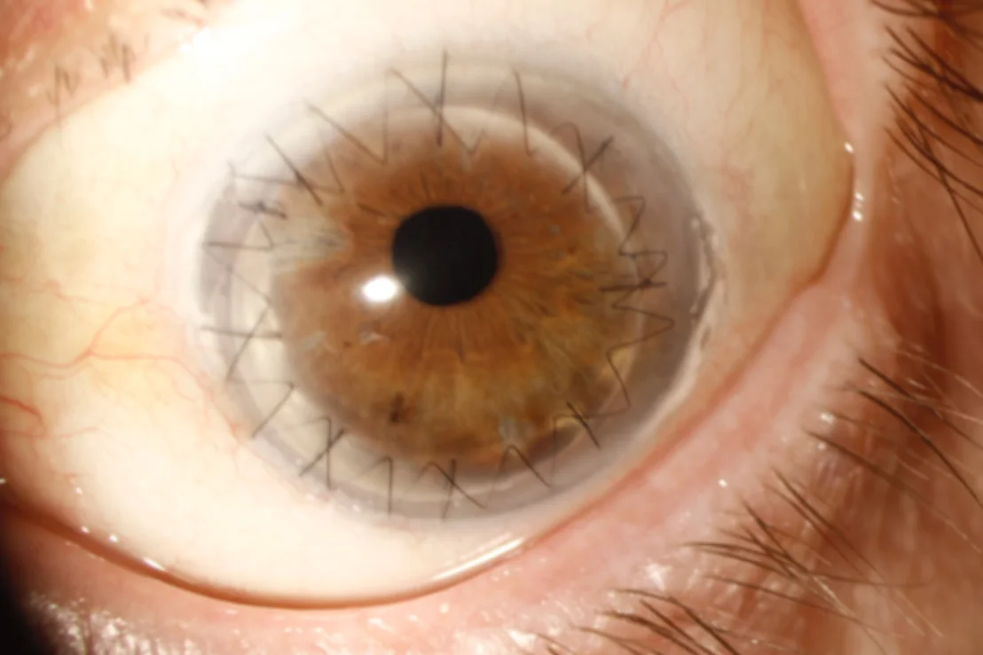 Patient’s eye with a corneal transplant and stitches still in place.