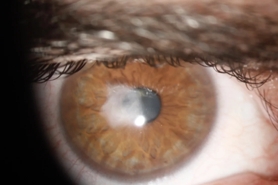 Photograph of a patient’s eye showing Corneal Scarring.
