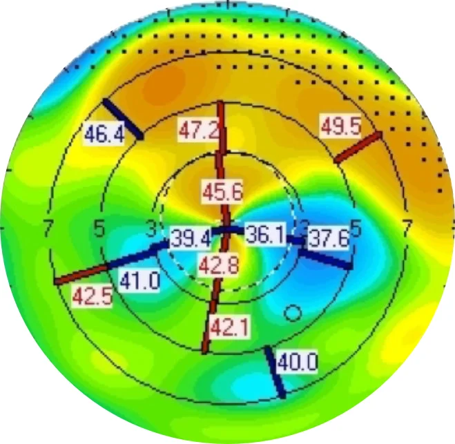 Corneal topography showing Irregular Astigmatism in a patient’s eye.