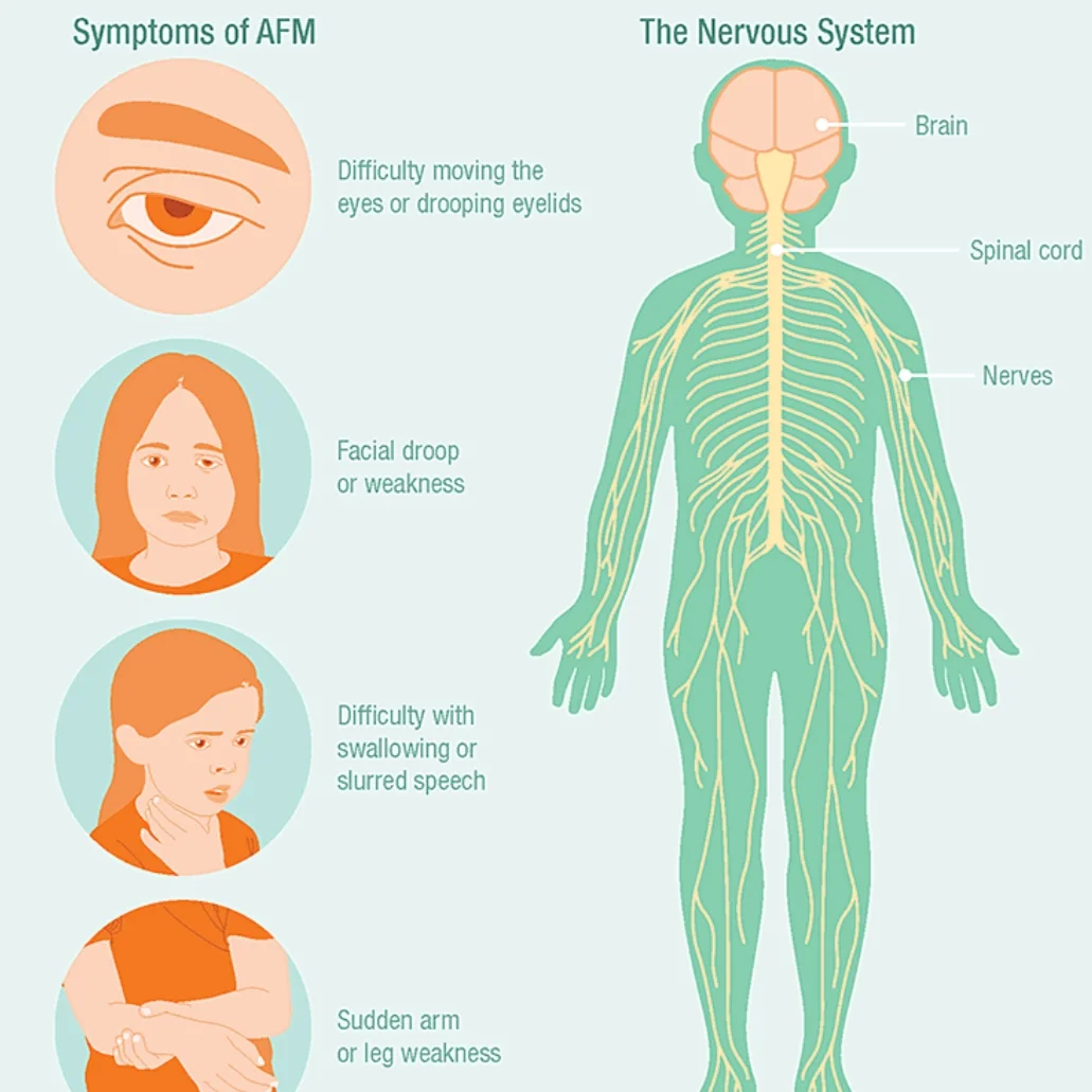 Acute Flaccid Myelitis&nbsp;