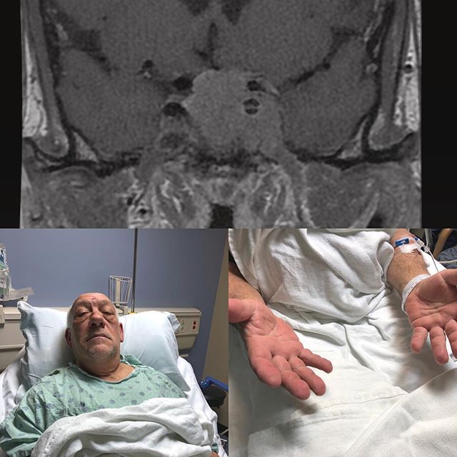 &ldquo;My work gloves don&rsquo;t fit anymore. I can&rsquo;t lose weight. Why am I so tired?&rdquo; Patient presents with a growth hormone secreting #pituitarytumor and features consistent with #acromegaly. He is back at work after successful endosco