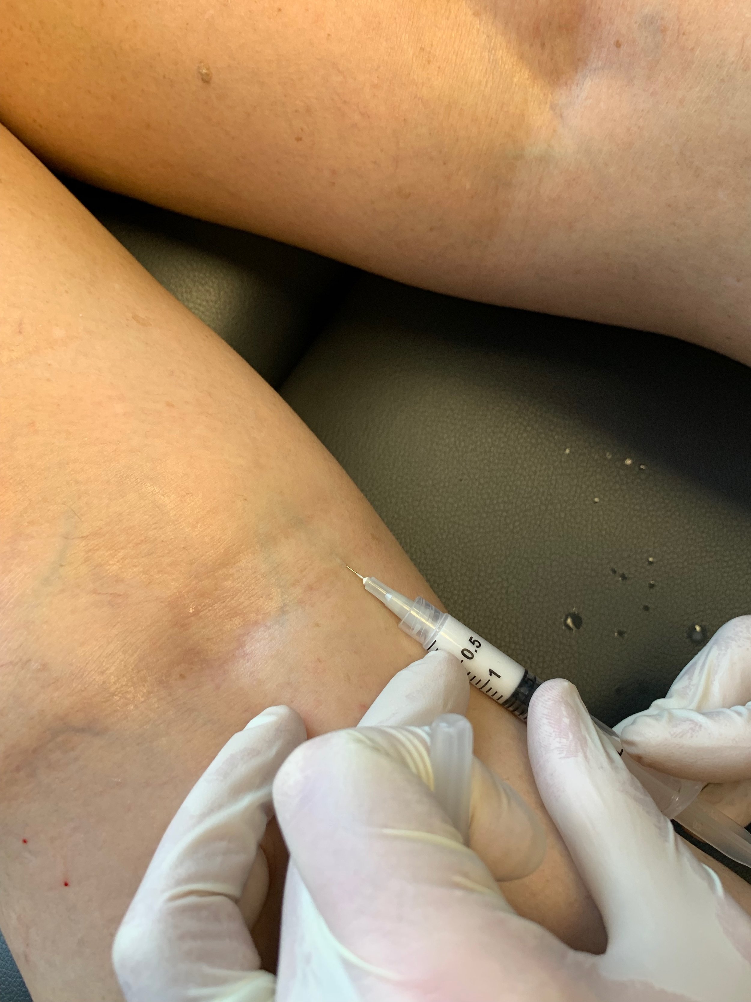 The unsightly vein is accessed with a small needle, and the chemical is injected.